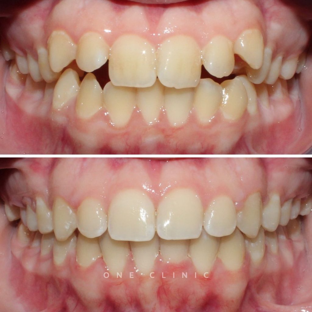 Ortodontia - Caso 2